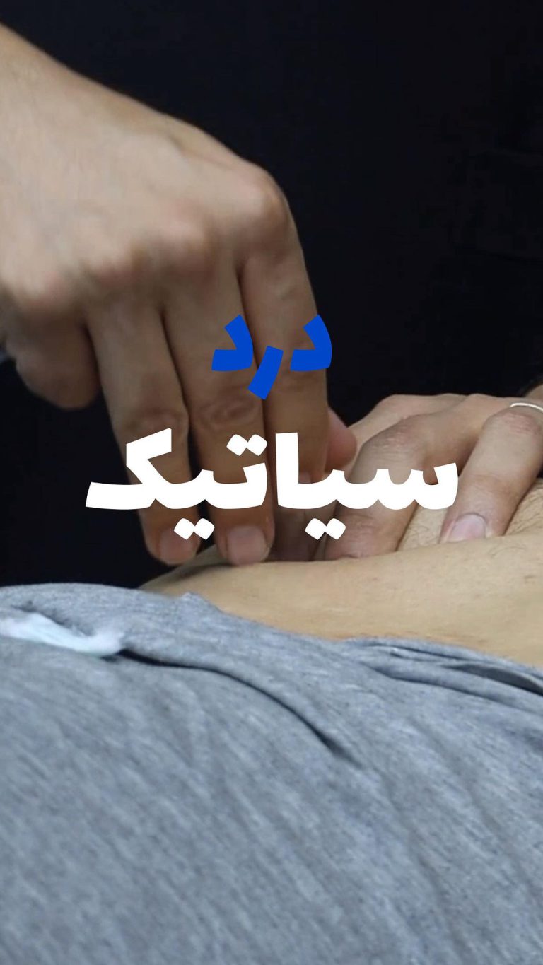 فیزیوتراپی تهران درد سیاتیک