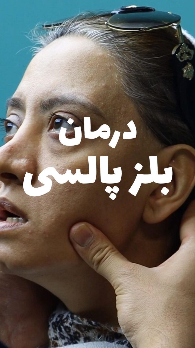 فیزیوتراپی تهران فیزیوتراپی صورت درمان بلزپااسی
