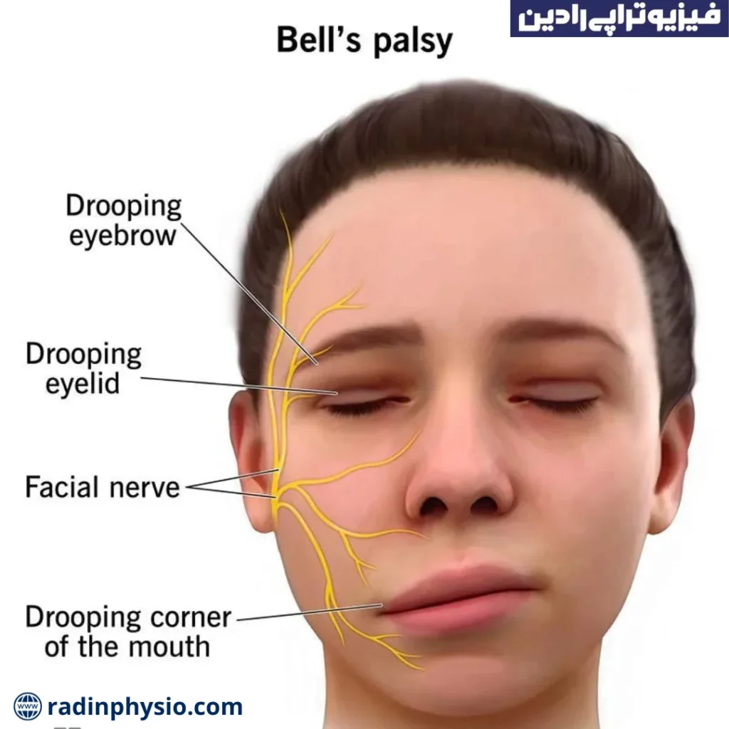 درمان بلزپالسی،فلچ بل، فیزیوتراپی عصب صورت (4)