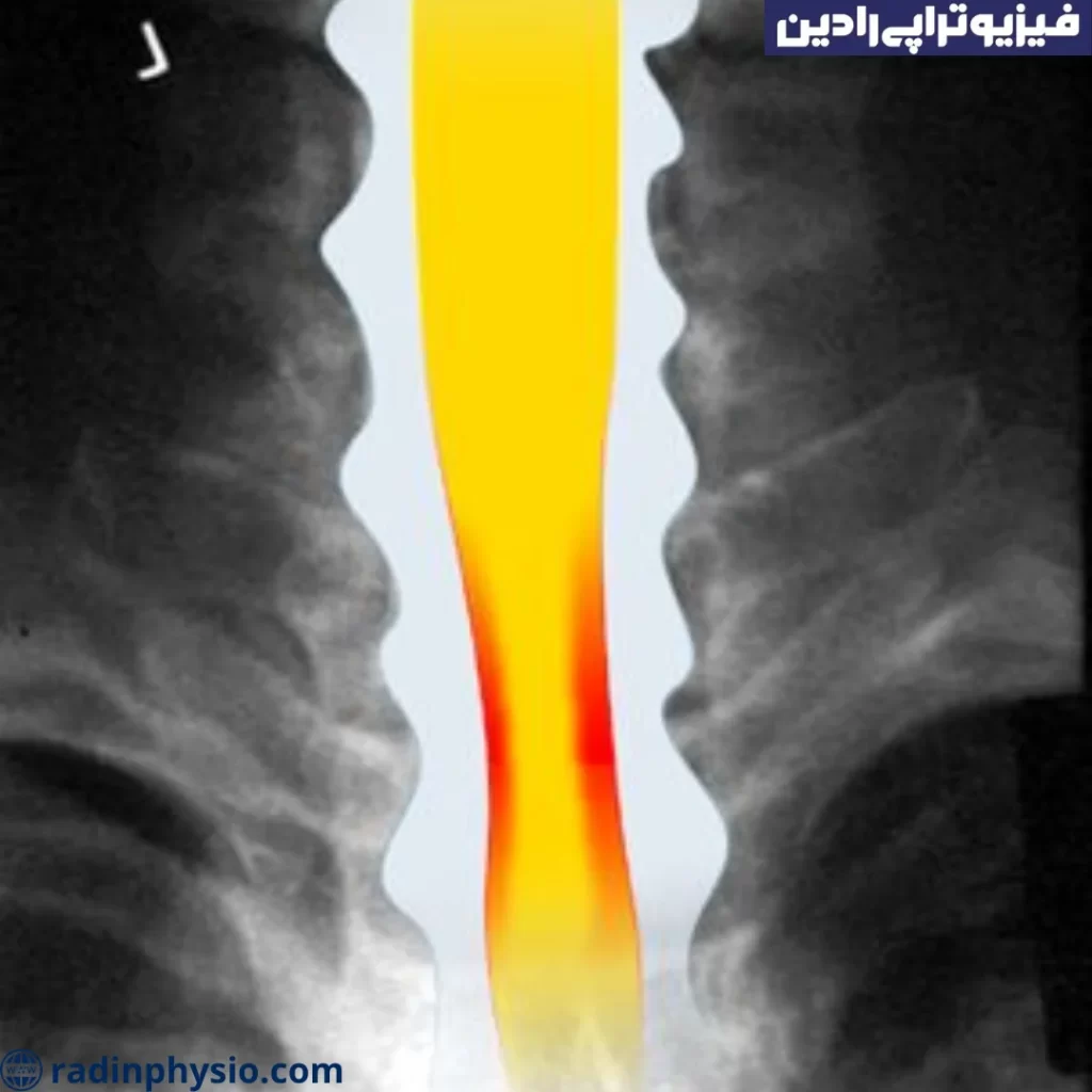 تنگی کانال نخاعی کمری (Lumbar spinal stenosis)