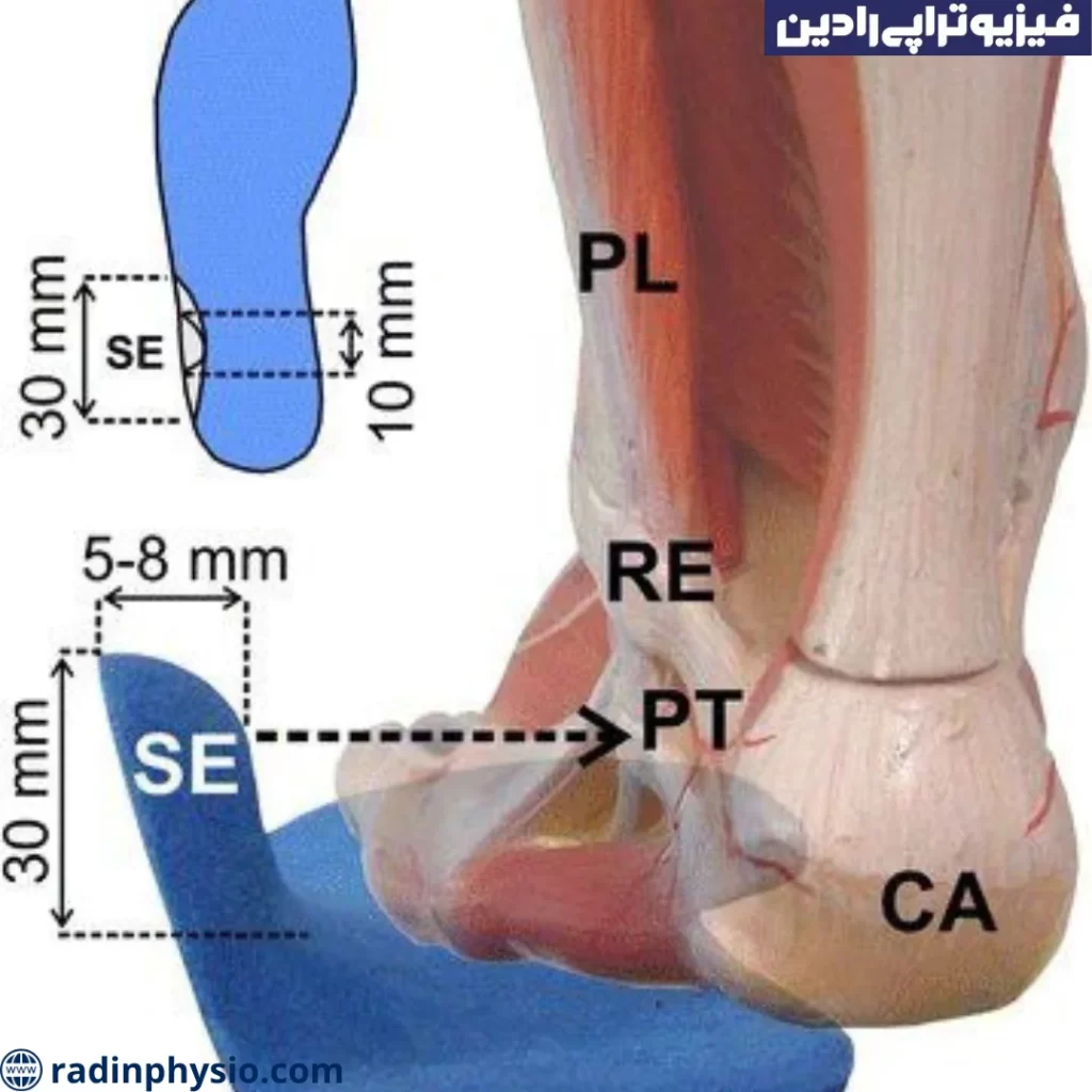 درمان اختلاف طول پا با کفی طبی