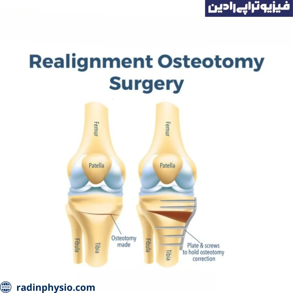 فیزیوتراپی پس از استئوتومی