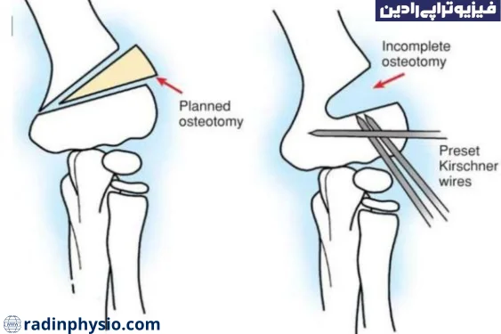 عمل استئوتومی پا