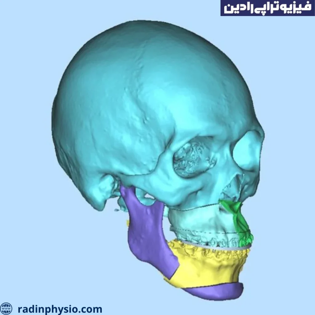 عمل استئوتومی فک