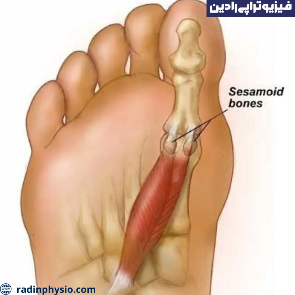 فیزیوتراپی التهاب استخوان سزاموئید