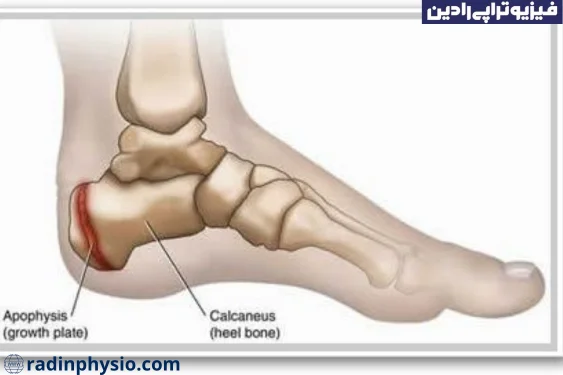 آپوفیزیت کالکانه