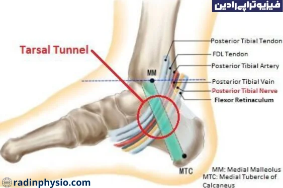 درمان سندروم تونل تارسال