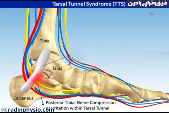 درمان سندروم تونل تارسال