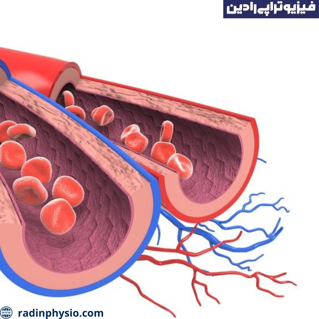 فیزیوتراپی واریس لگن