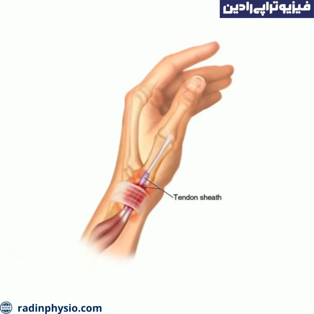 آب درمانی تنوسینوویت چرکی