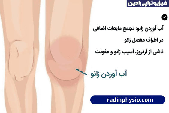 درمان آب آوردن زانو