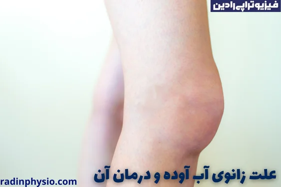 درمان آب آوردن زانو